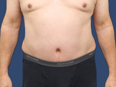 Abdominoplasty Before & After Gallery - Patient 64072870 - Image 2