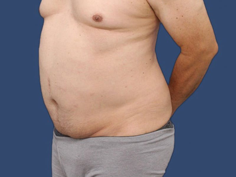 Abdominoplasty Before & After Gallery - Patient 64072870 - Image 3