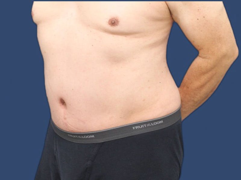 Abdominoplasty Before & After Gallery - Patient 64072870 - Image 4
