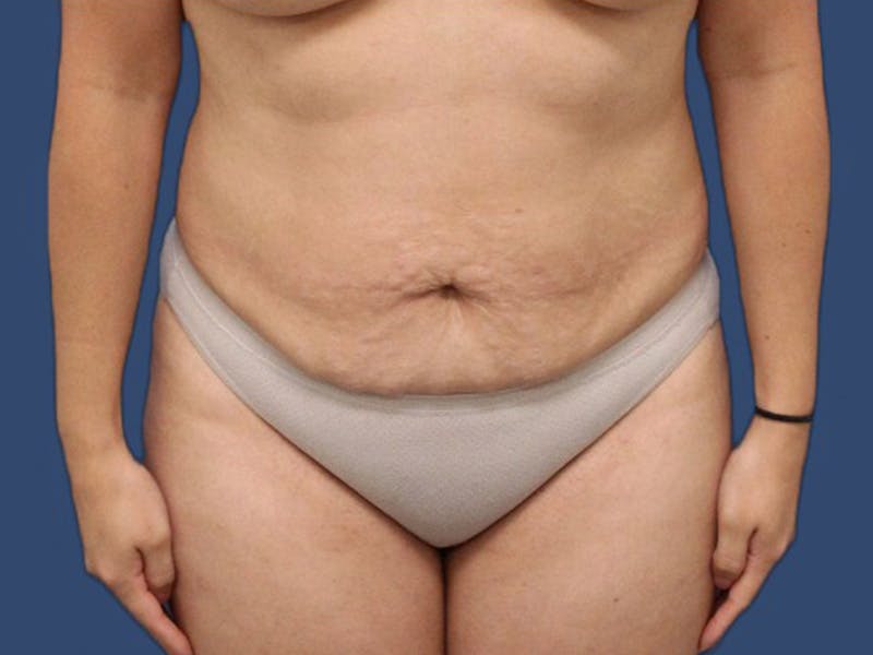 Tummy Tuck Before & After Gallery - Patient 64098831 - Image 1