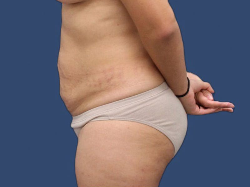 Tummy Tuck Before & After Gallery - Patient 64098831 - Image 3