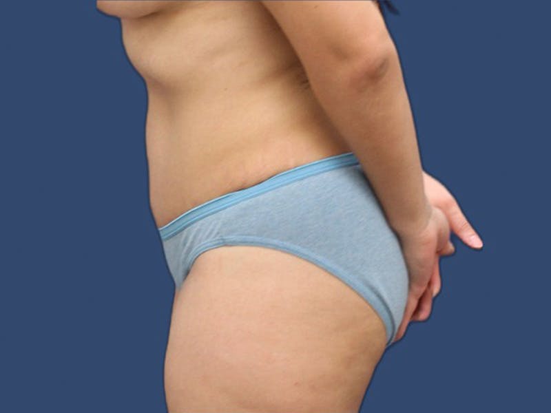 Tummy Tuck Before & After Gallery - Patient 64098831 - Image 4