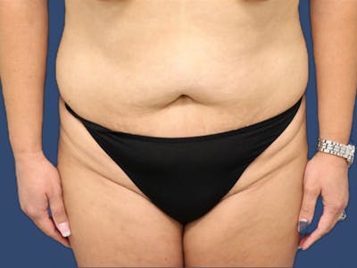 Tummy Tuck Before & After Gallery - Patient 64403125 - Image 1