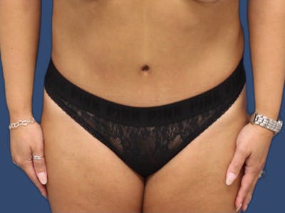 Tummy Tuck Before & After Gallery - Patient 64403125 - Image 2