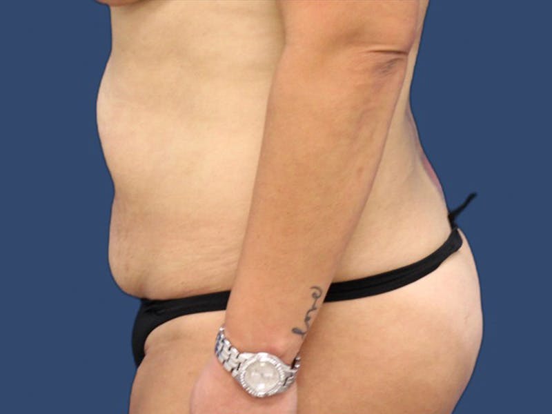 Tummy Tuck Before & After Gallery - Patient 64403125 - Image 3