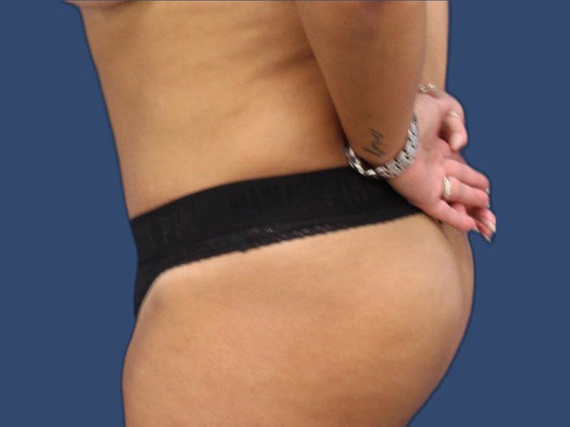 Tummy Tuck Before & After Gallery - Patient 64403125 - Image 4