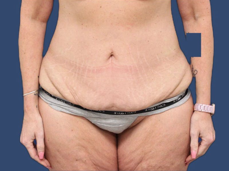 Tummy Tuck Before & After Gallery - Patient 73512060 - Image 1