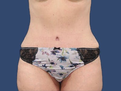 Tummy Tuck Before & After Gallery - Patient 73512060 - Image 2