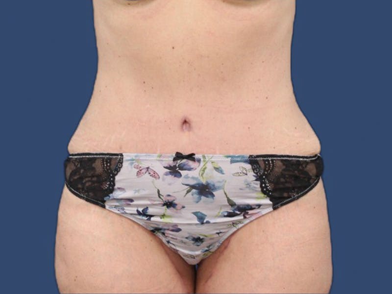 Tummy Tuck Before & After Gallery - Patient 73512060 - Image 2