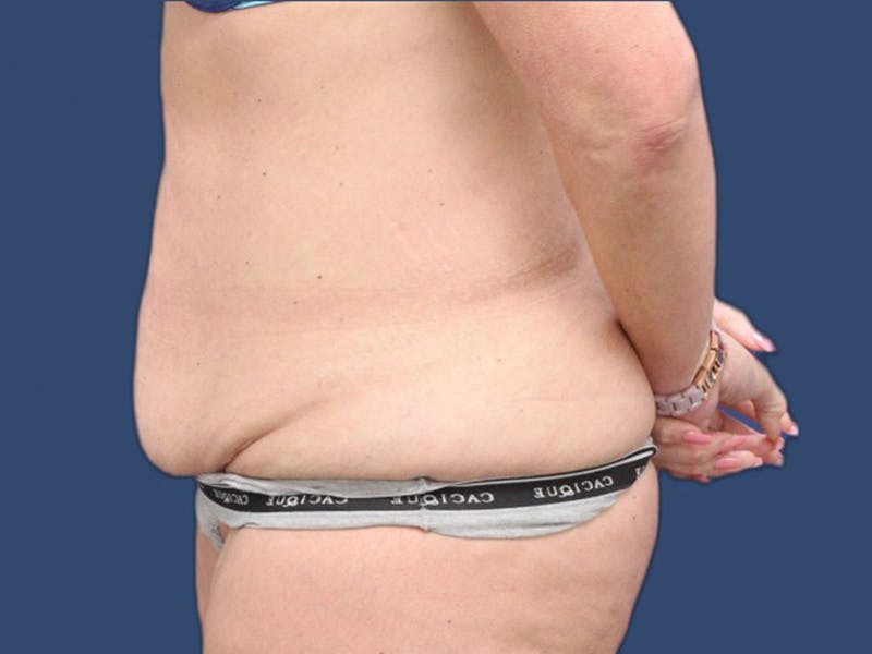 Tummy Tuck Before & After Gallery - Patient 73512060 - Image 3