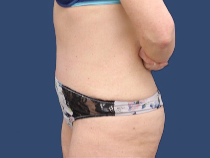 Tummy Tuck Before & After Gallery - Patient 73512060 - Image 4