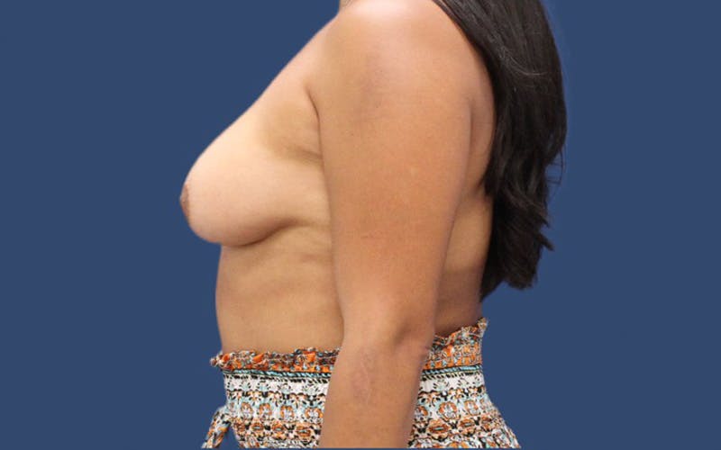 Breast Augmentation Before & After Gallery - Patient 92127328 - Image 3