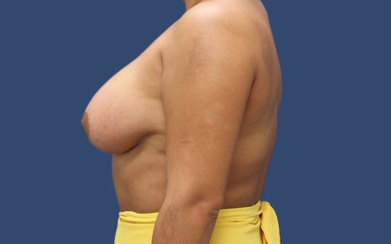 Breast Augmentation Before & After Gallery - Patient 92127328 - Image 4
