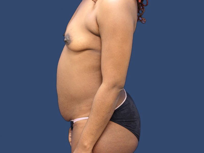 Tummy Tuck Before & After Gallery - Patient 106385284 - Image 3