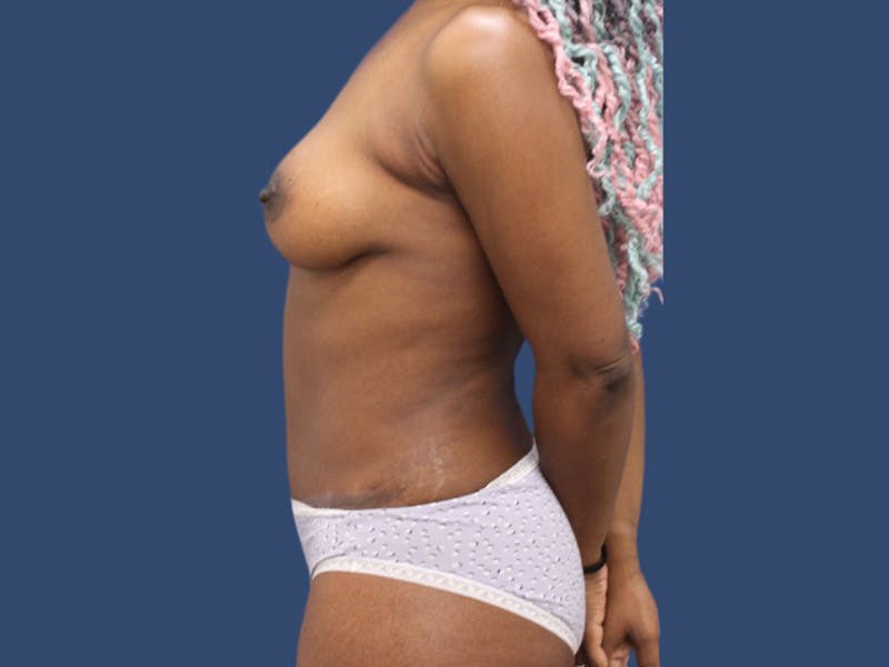 Tummy Tuck Before & After Gallery - Patient 106385284 - Image 4