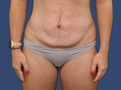 Tummy Tuck Before & After Gallery - Patient 105632058 - Image 1
