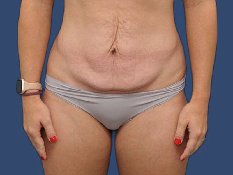 Tummy Tuck Before & After Gallery - Patient 105632058 - Image 1