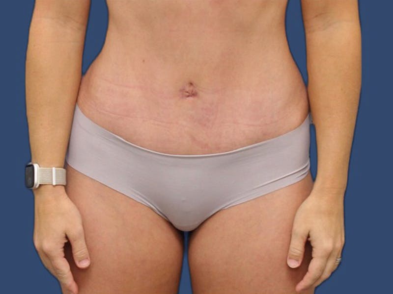 Tummy Tuck Before & After Gallery - Patient 105632058 - Image 2