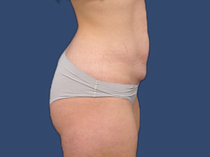 Tummy Tuck Before & After Gallery - Patient 105632058 - Image 3