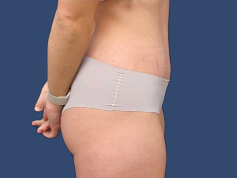 Tummy Tuck Before & After Gallery - Patient 105632058 - Image 4