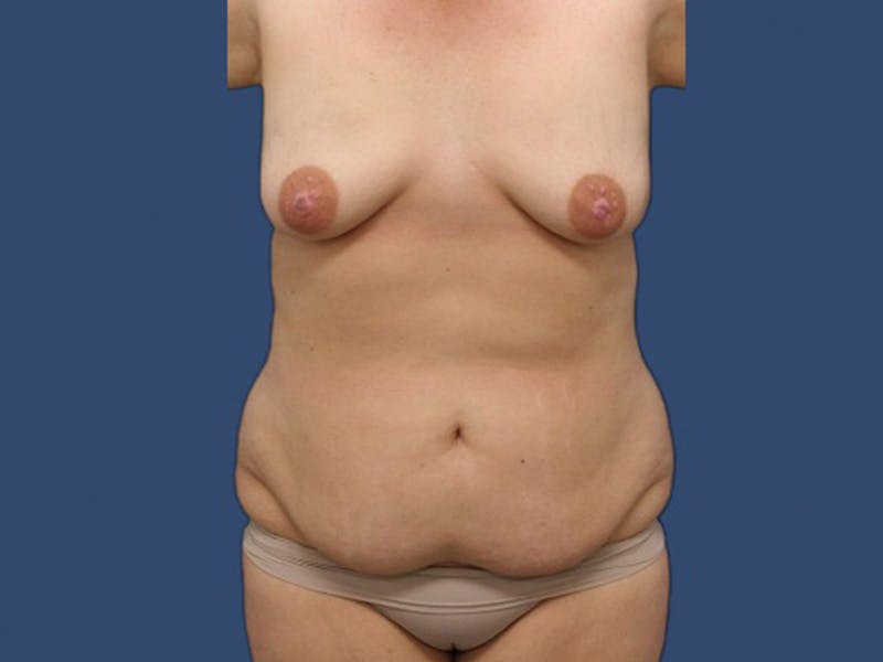 Mommy Makeover Before & After Gallery - Patient 106456041 - Image 1