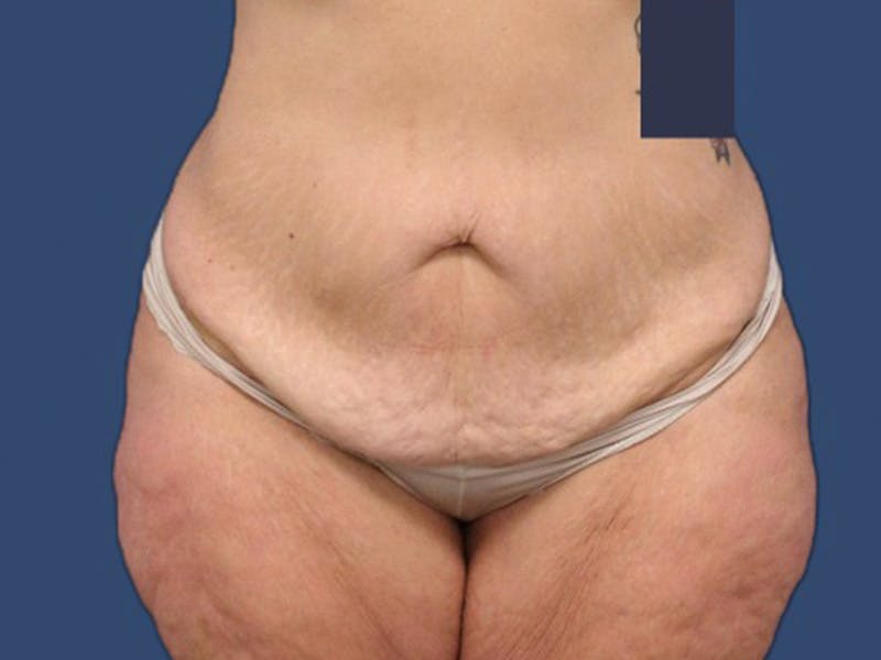 Tummy Tuck Before & After Gallery - Patient 106456042 - Image 1