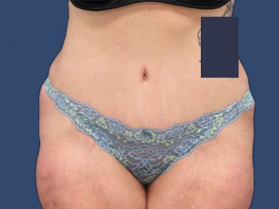 Tummy Tuck Before & After Gallery - Patient 106456042 - Image 2