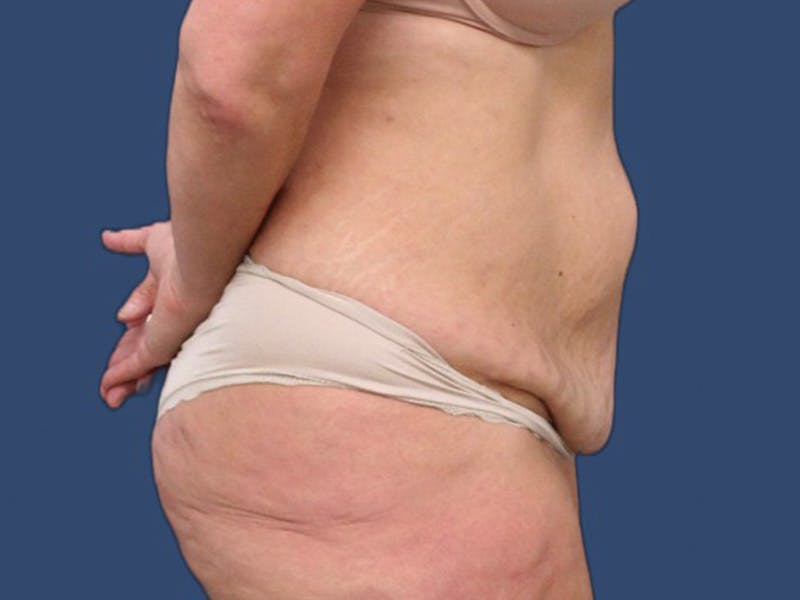 Tummy Tuck Before & After Gallery - Patient 106456042 - Image 3