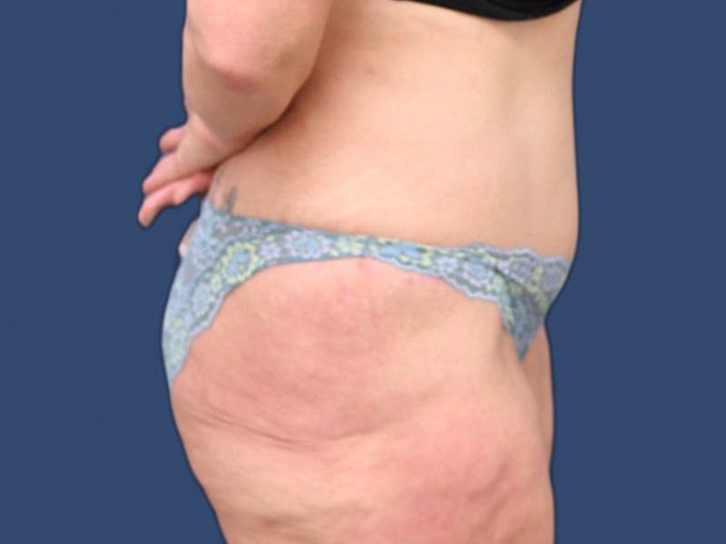 Tummy Tuck Before & After Gallery - Patient 106456042 - Image 4