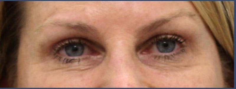 Eyelid Surgery Before & After Gallery - Patient 106456043 - Image 2
