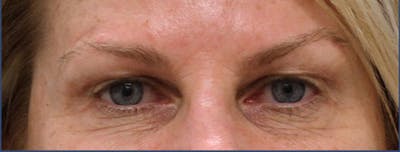 Eyelid Surgery Before & After Gallery - Patient 106456043 - Image 1