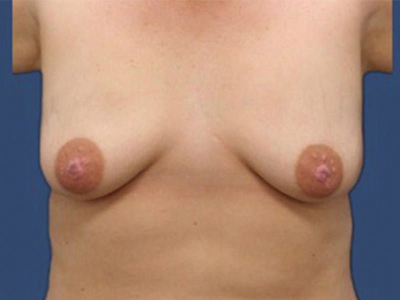 Breast Lift Before & After Gallery - Patient 106464837 - Image 1