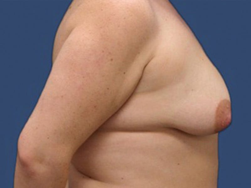 Breast Lift Before & After Gallery - Patient 106464837 - Image 3