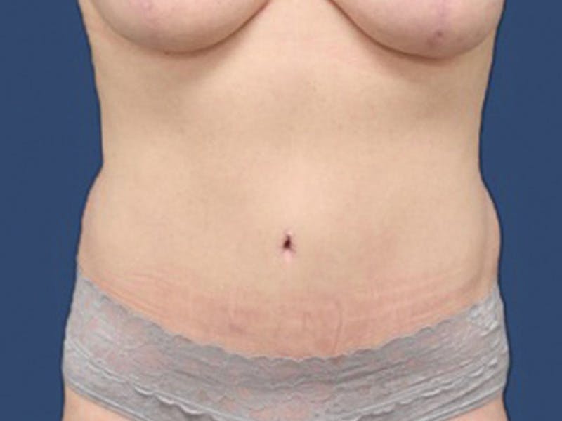 Tummy Tuck Before & After Gallery - Patient 106464848 - Image 2