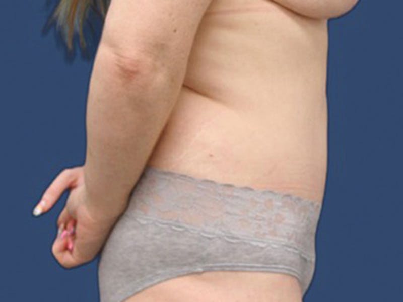 Tummy Tuck Before & After Gallery - Patient 106464848 - Image 4