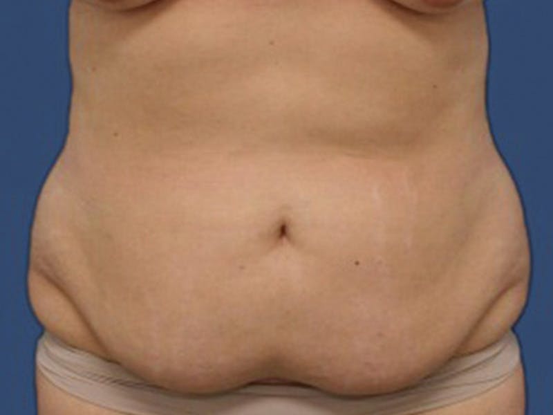 Tummy Tuck Before & After Gallery - Patient 106464849 - Image 1