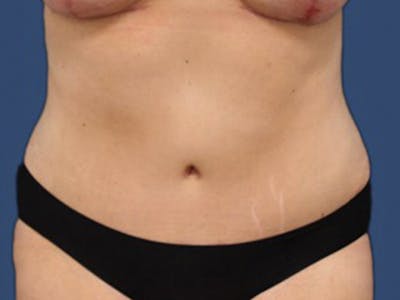 Tummy Tuck Before & After Gallery - Patient 106464849 - Image 2