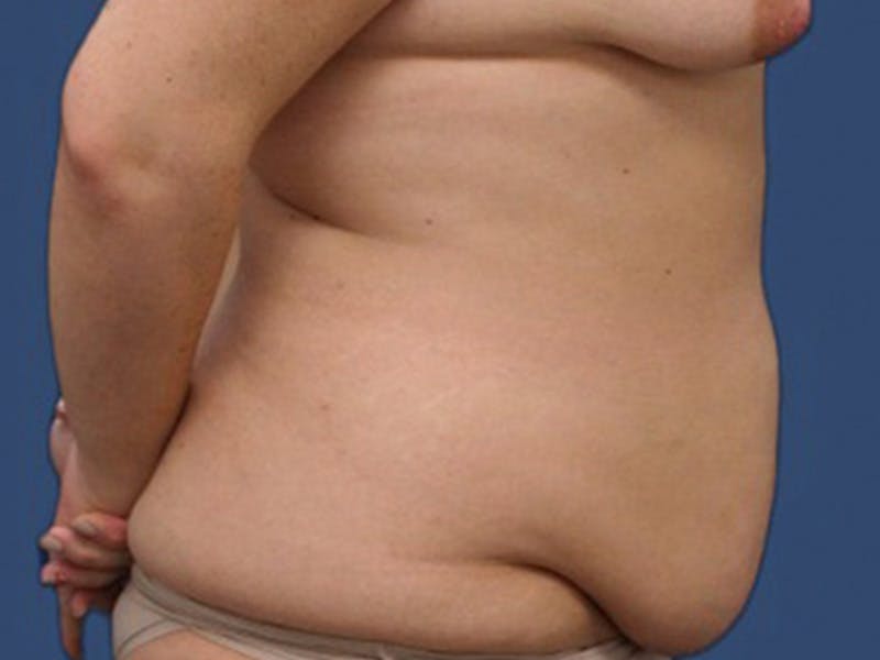 Tummy Tuck Before & After Gallery - Patient 106464849 - Image 3