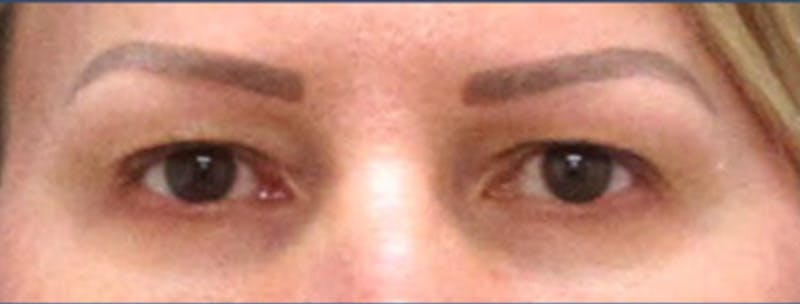 Eyelid Surgery Before & After Gallery - Patient 106476429 - Image 1