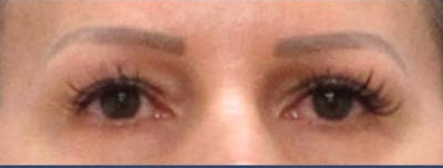 Eyelid Surgery Before & After Gallery - Patient 106476429 - Image 2