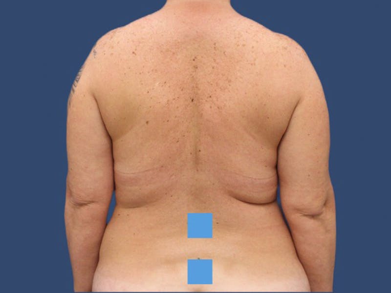 Liposuction Before & After Gallery - Patient 106476420 - Image 1