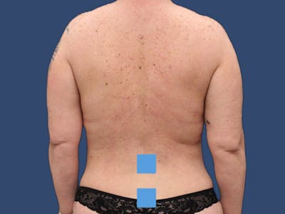 Liposuction Before & After Gallery - Patient 106476420 - Image 2