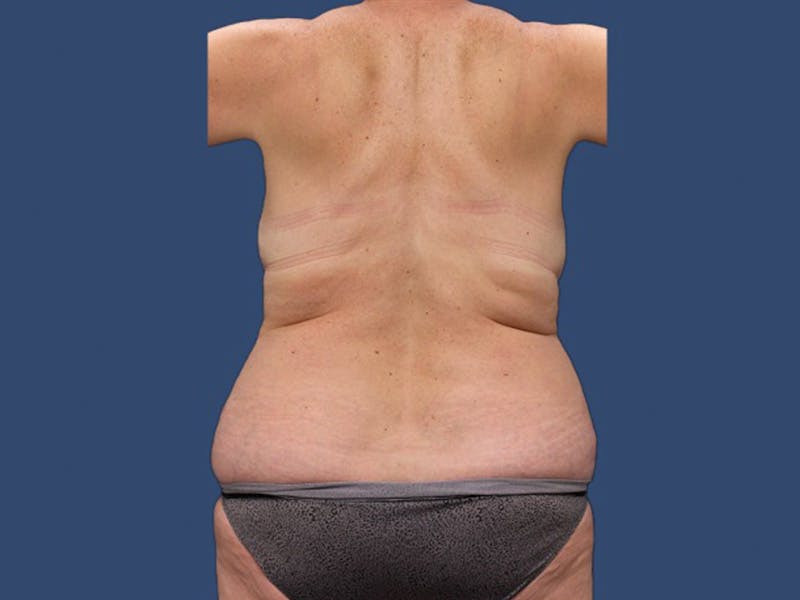 Liposuction Before & After Gallery - Patient 106476417 - Image 1