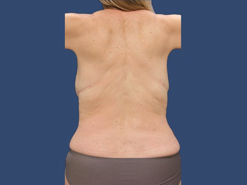 Liposuction in San Antonio Before & After Photos