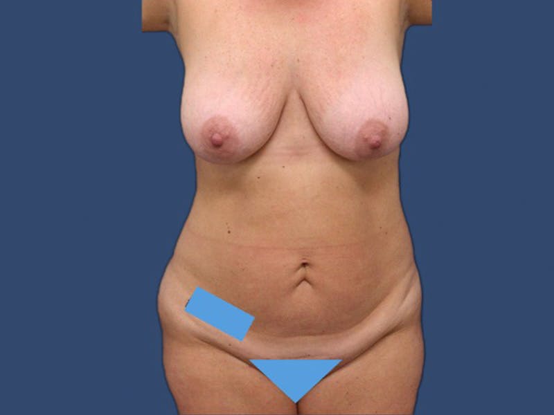 Breast Augmentation Before & After Gallery - Patient 106476435 - Image 1