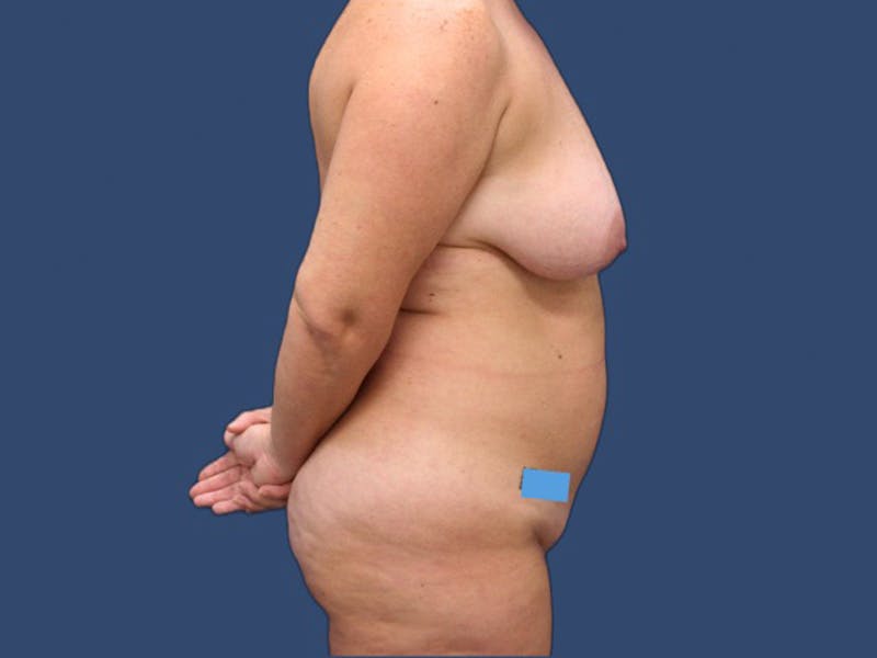 Breast Augmentation Before & After Gallery - Patient 106476435 - Image 3