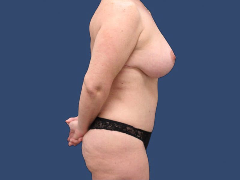 Tummy Tuck Before & After Gallery - Patient 106476433 - Image 4