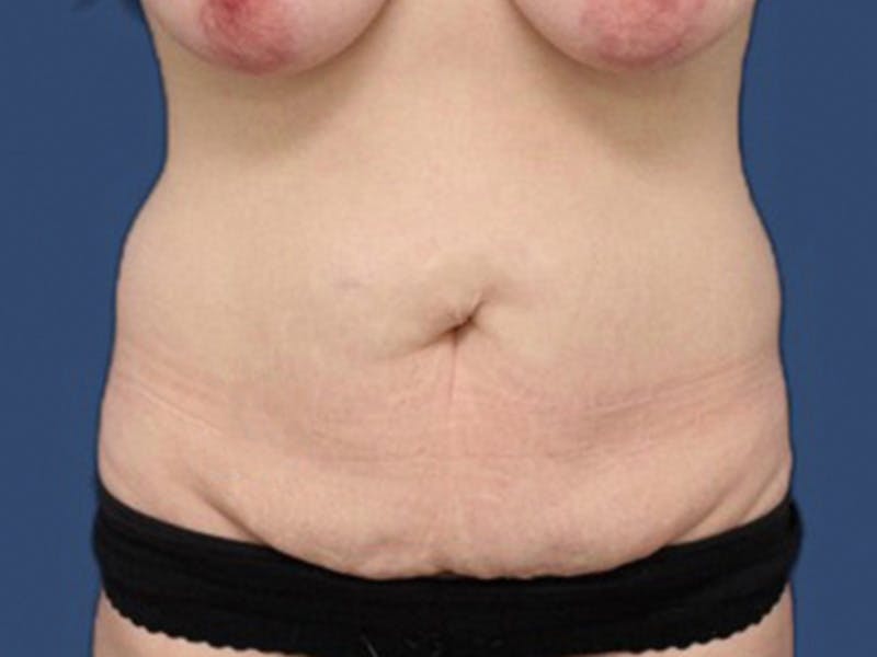 Tummy Tuck Before & After Gallery - Patient 106464848 - Image 1