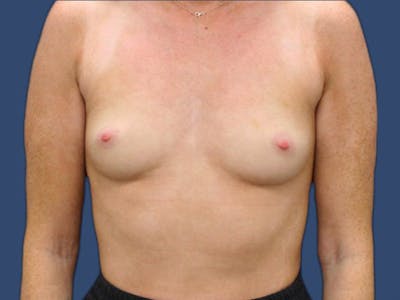 Breast Augmentation Before & After Gallery - Patient 114210533 - Image 1