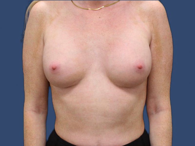 Breast Augmentation Before & After Gallery - Patient 114210533 - Image 2